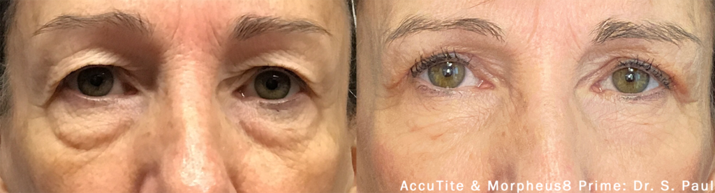 accutite-morpheus-prime-before-after-dr-s-paul-preview-1